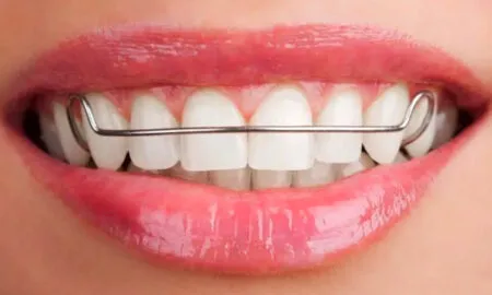 Ортодонтические пластинки: улучшение улыбки и качества жизни