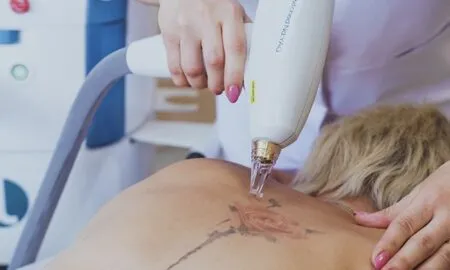 Безопасное удаление татуировок лазером: что нужно учесть