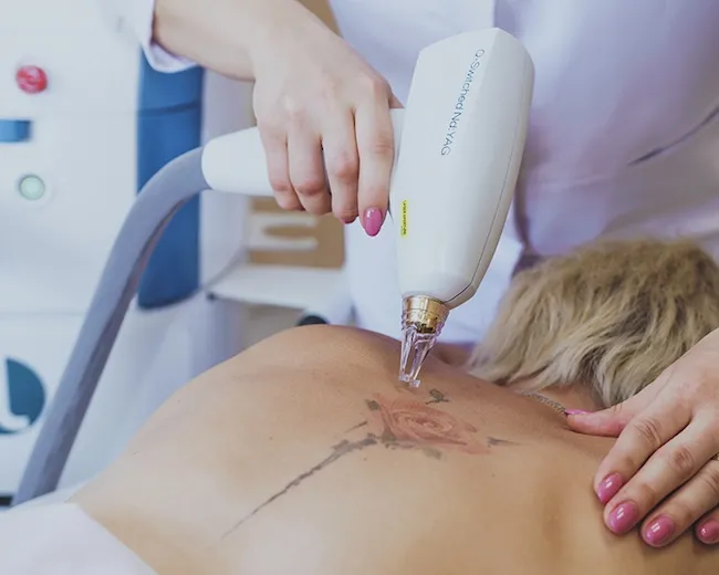 Безопасное удаление татуировок лазером: что нужно учесть