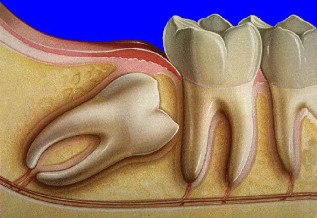 Зуб мудрості 