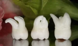 Зуби мудрості